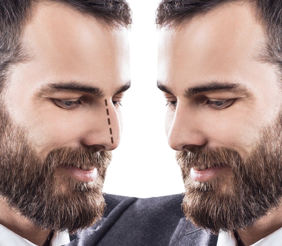 Achieve a more masculine profile with a Revision Rhinoplasty customized for Male patients