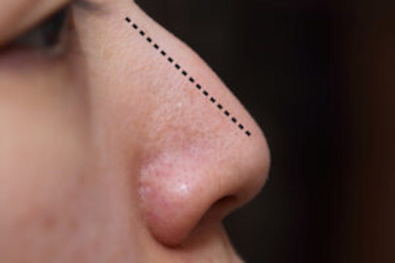 nose with line illustration on it