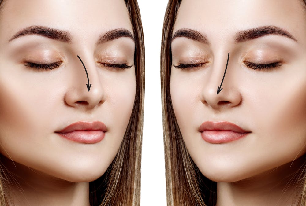 woman's nose comparison