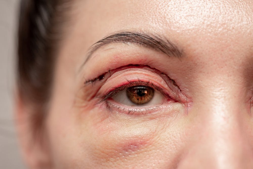 Safeguarding post-blepharoplasty visual health is crucial due to potential risks like vision loss or impairments.