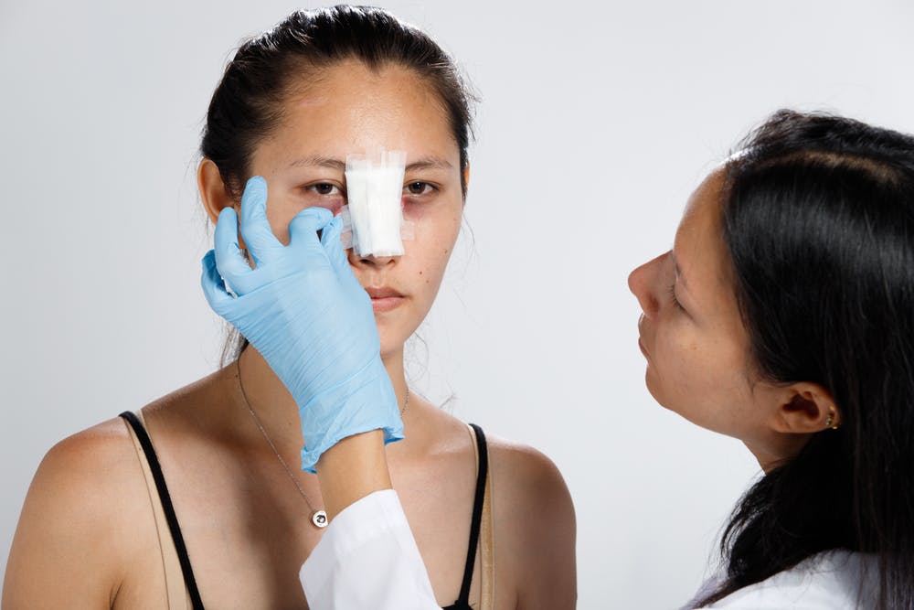 The gradual resolution of swelling in revision rhinoplasty spans over 9–12 months, shaping the nose's final form.