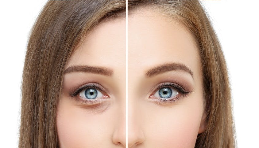 Upper blepharoplasty tackles excess skin and fat for cosmetic enhancement and improved vision, aiding those with sagging eyelids