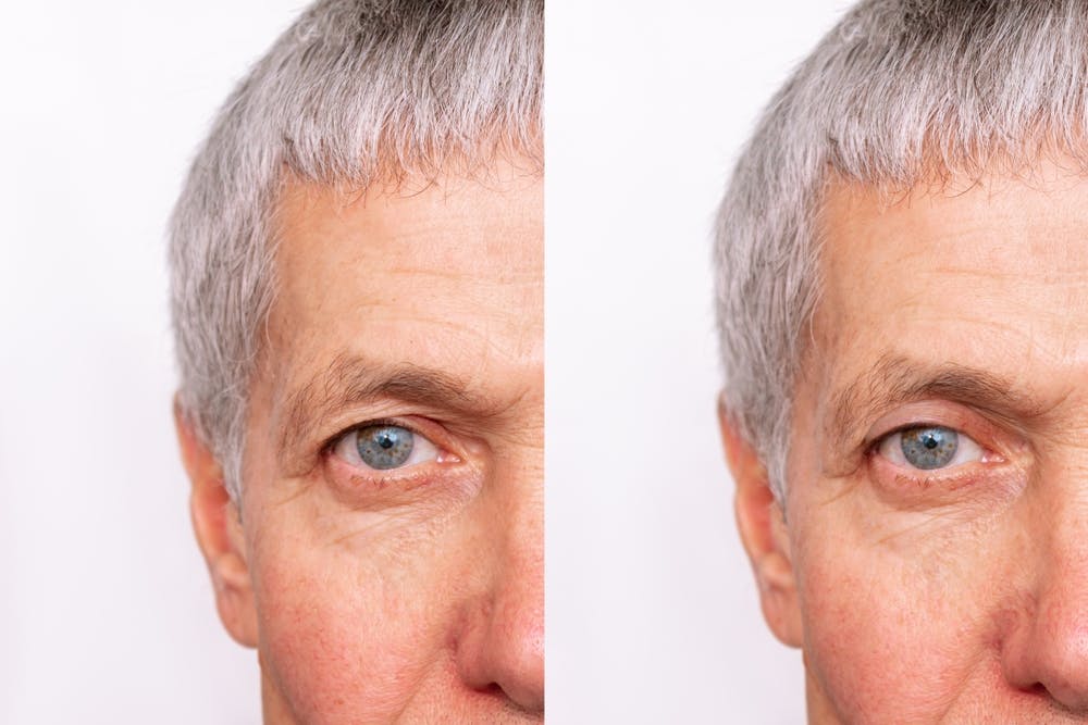 Strategic incision placement in upper eyelid surgery aims to minimize scarring while accommodating unique anatomical needs for a natural outcome
