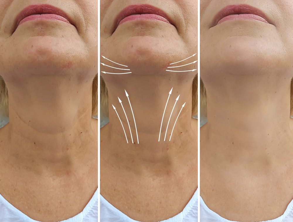 Before and after sequence of Nefertiti Lift procedure showing possible side effects.
