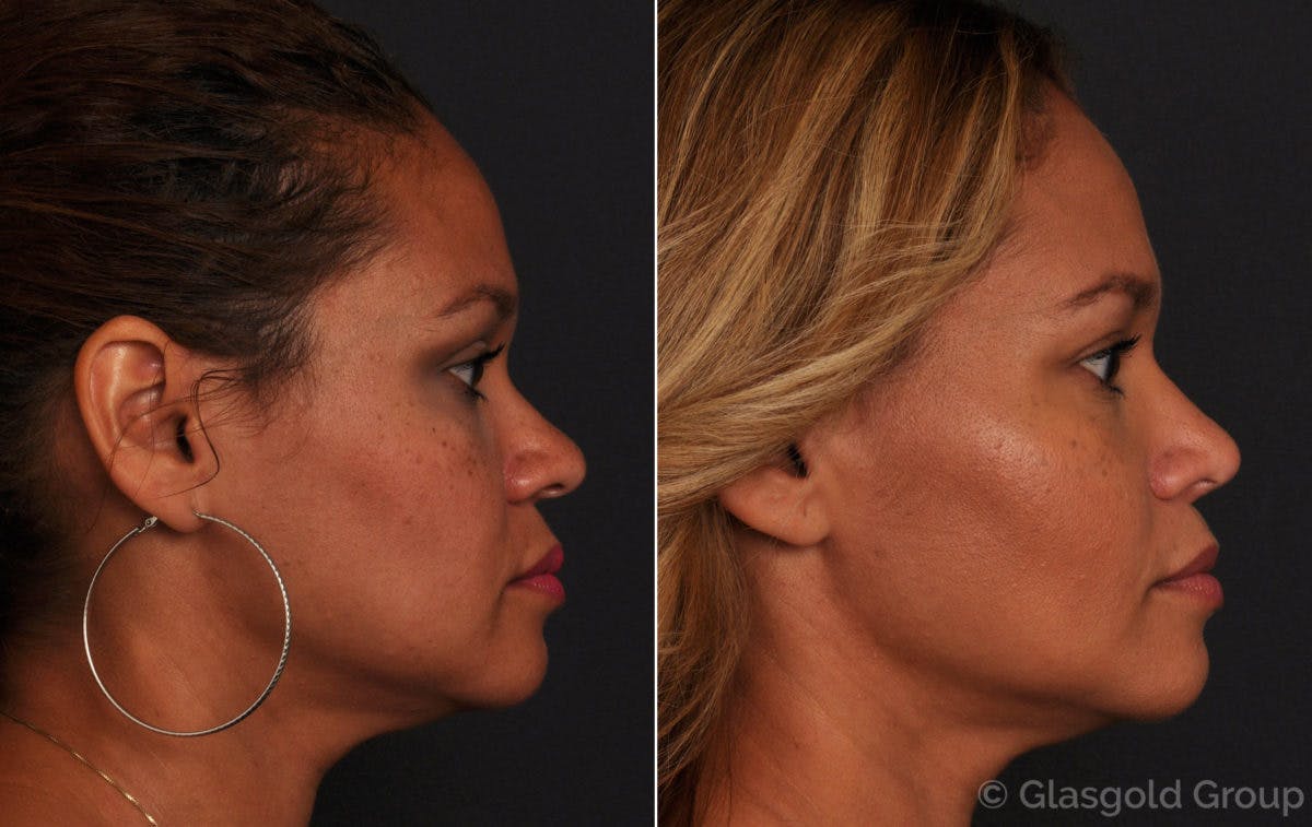 Ethnic Rhinoplasty Before & After Gallery - Patient 264251 - Image 1