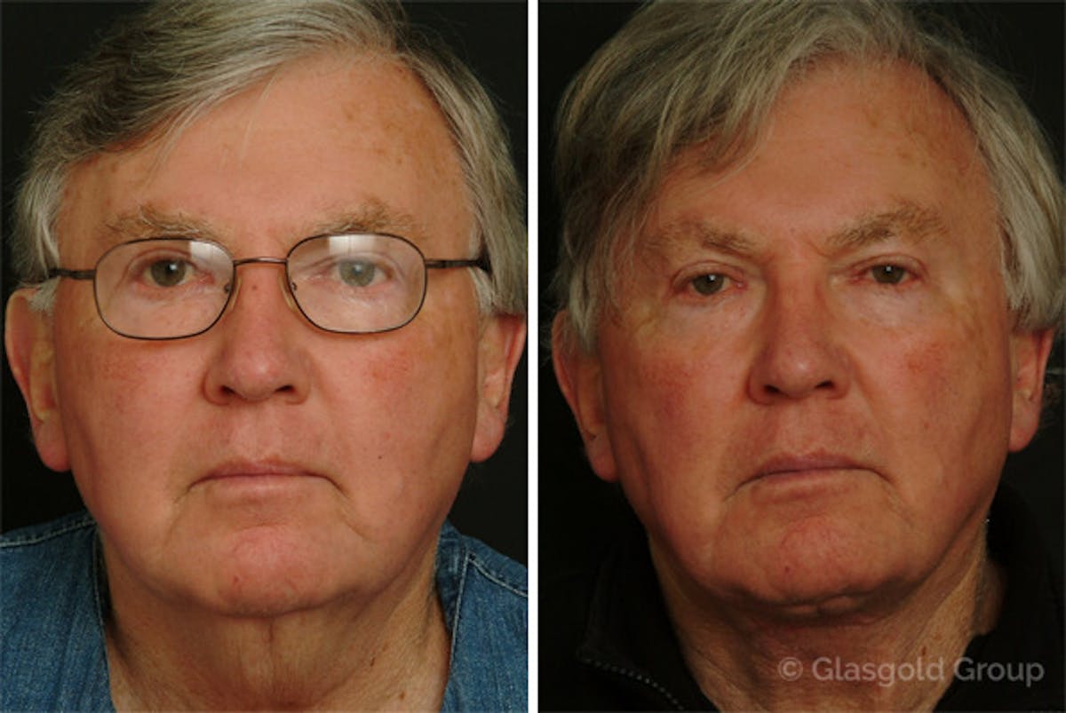 Male Necklift Before & After Gallery - Patient 285317 - Image 2