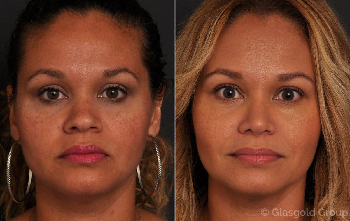 Ethnic Rhinoplasty Before & After Gallery - Patient 264251 - Image 2