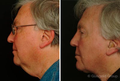 Male Necklift Before & After Gallery - Patient 285317 - Image 1