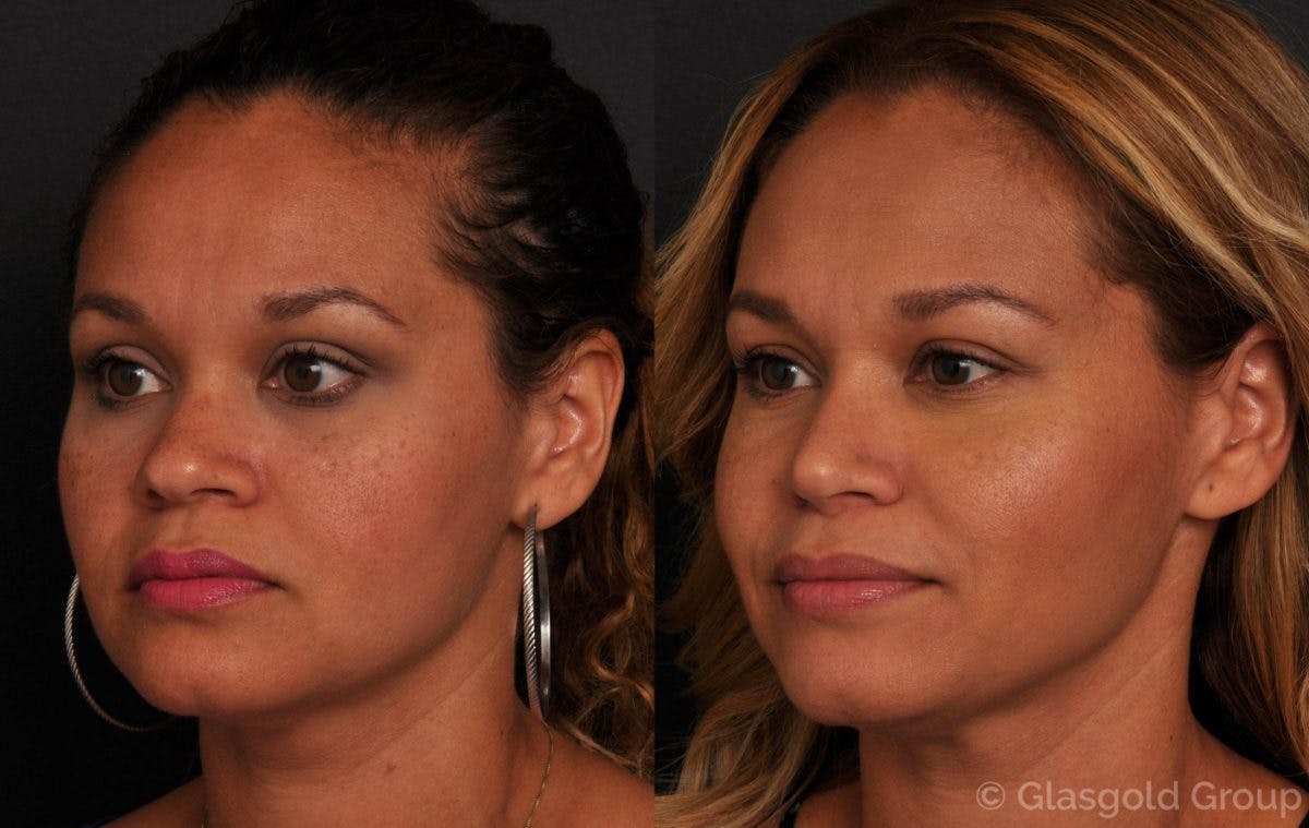 Ethnic Rhinoplasty Before & After Gallery - Patient 264251 - Image 3