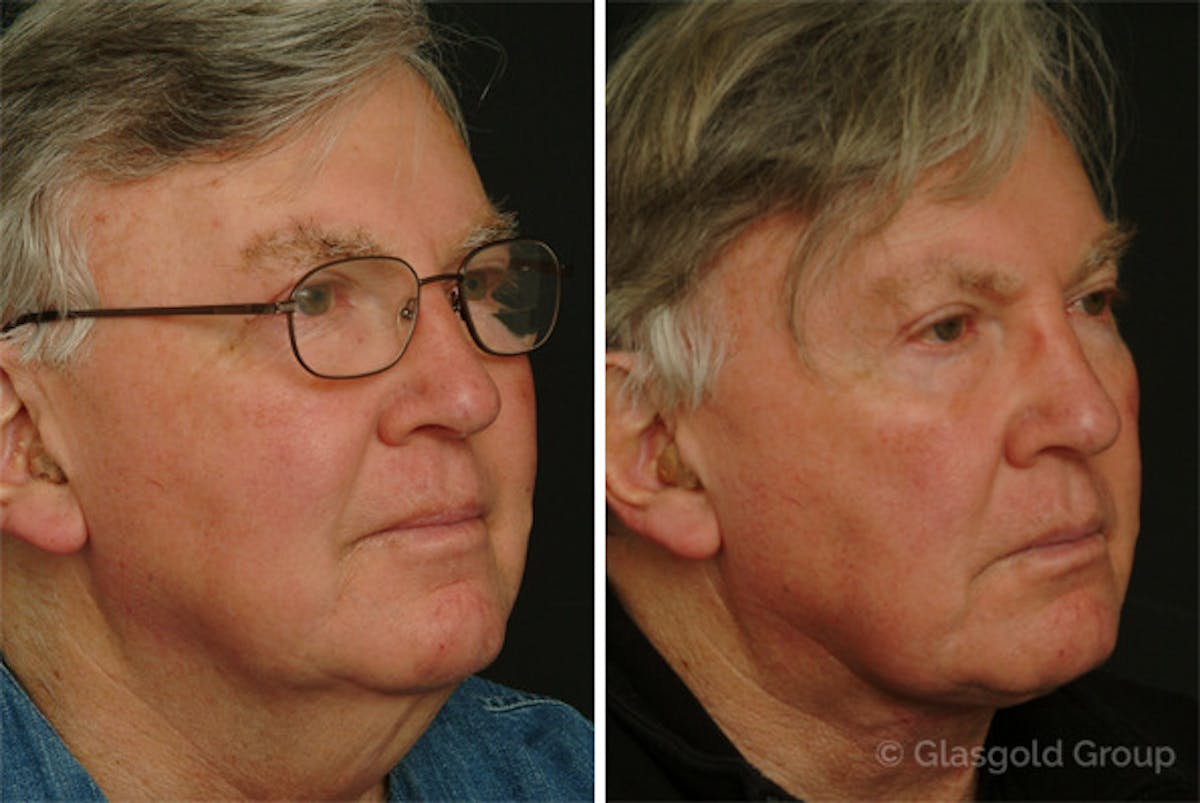 Male Necklift Before & After Gallery - Patient 285317 - Image 3