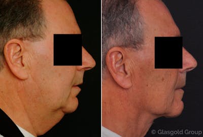 Male Necklift Before & After Gallery - Patient 203802 - Image 1