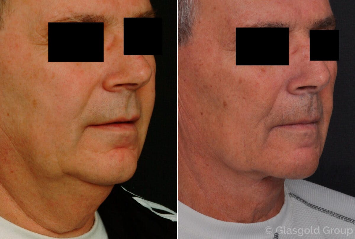 Male Necklift Before & After Gallery - Patient 203802 - Image 2