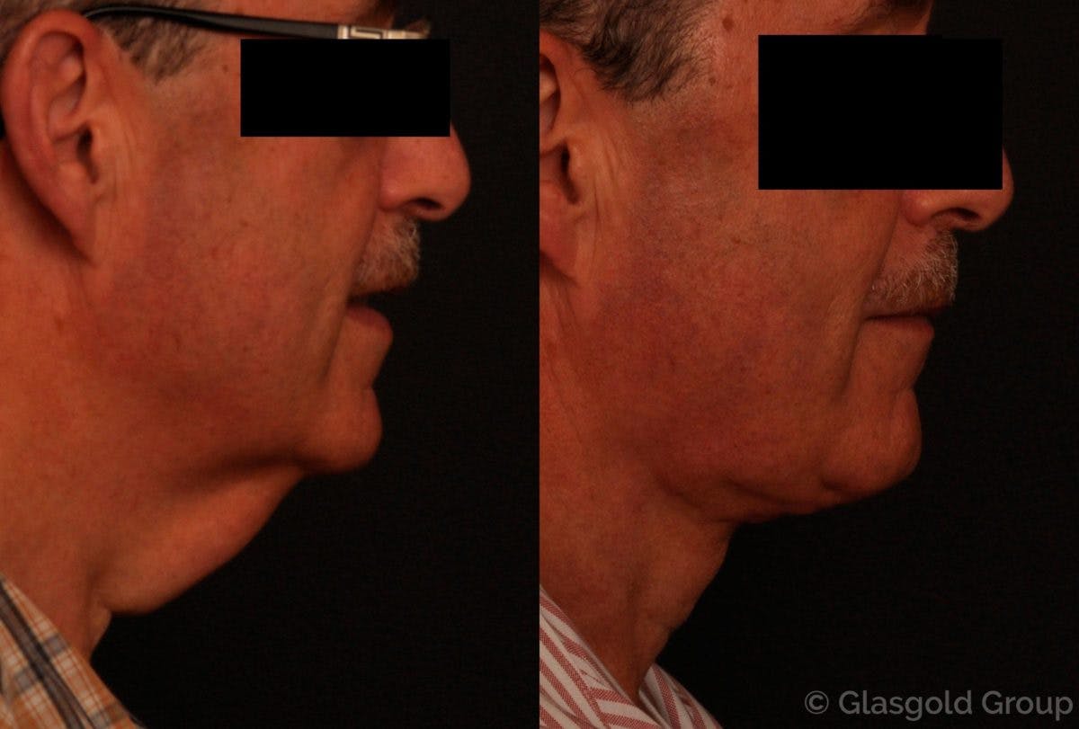 Male Necklift Before & After Gallery - Patient 195943 - Image 1