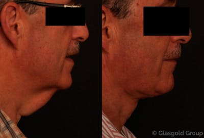 Male Necklift Before & After Gallery - Patient 195943 - Image 1