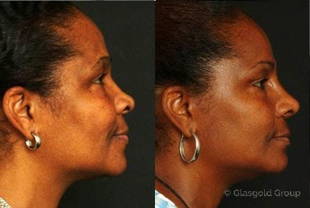 Ethnic Rhinoplasty Before & After Gallery - Patient 257188 - Image 1