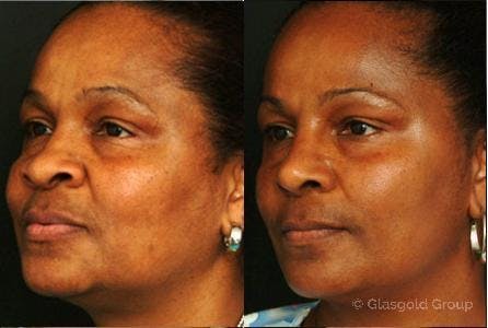 Ethnic Rhinoplasty Before & After Gallery - Patient 257188 - Image 2