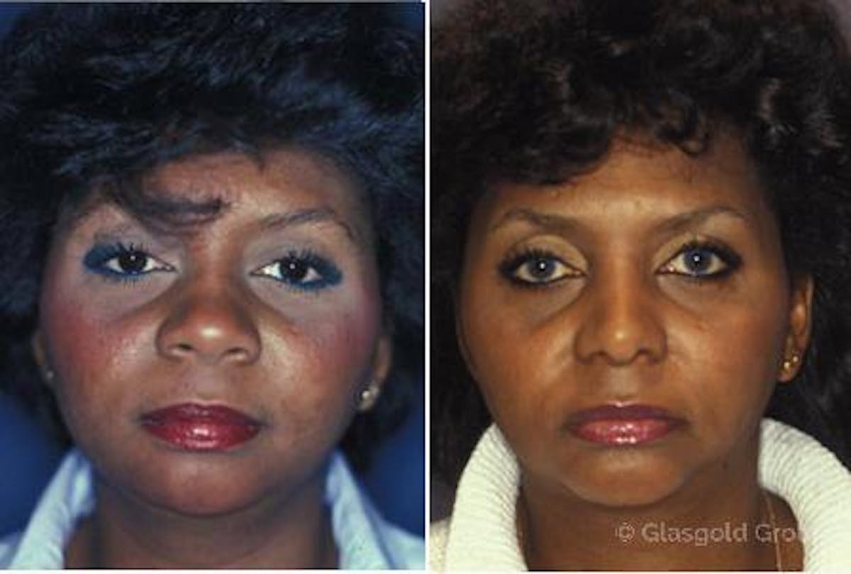 Ethnic Rhinoplasty Before & After Gallery - Patient 351832 - Image 1