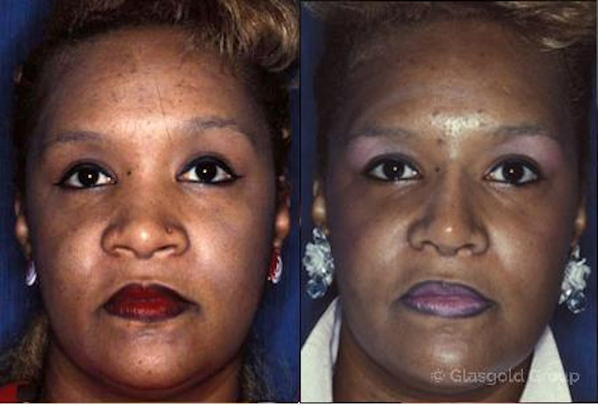 Ethnic Rhinoplasty Before & After Gallery - Patient 105115 - Image 1