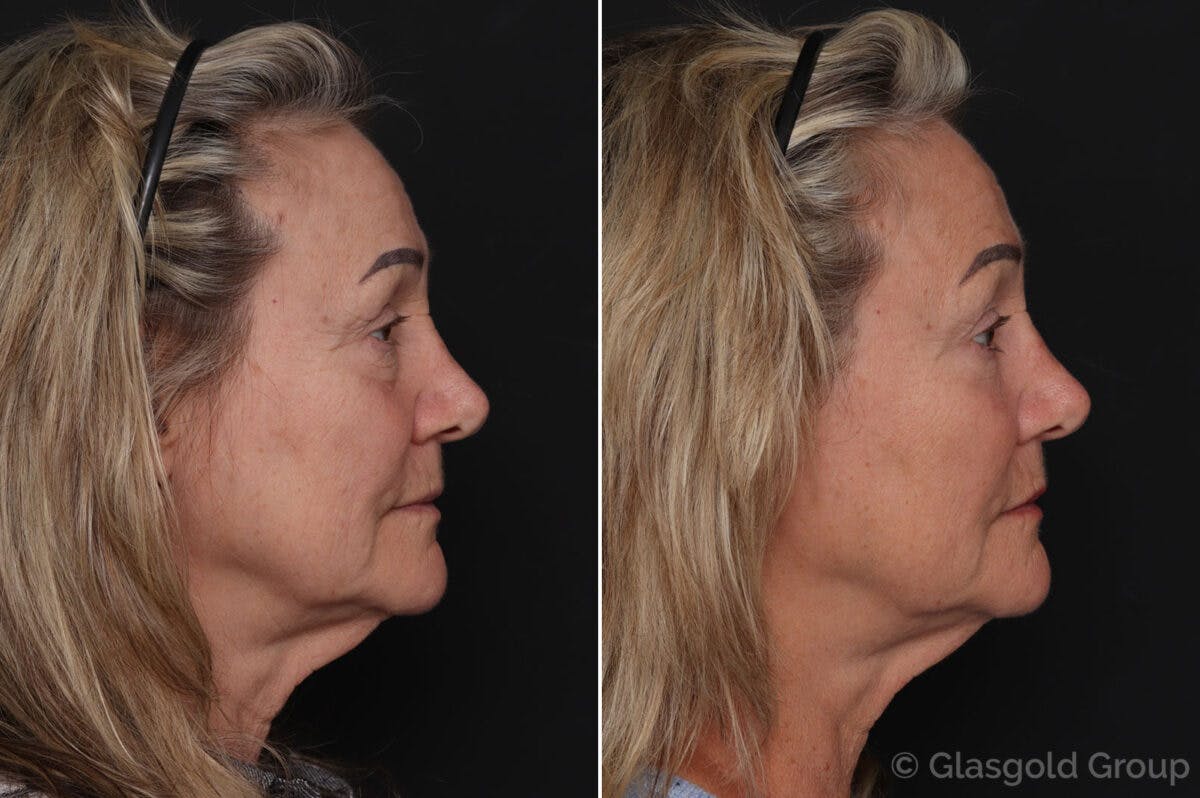 Lower Eyelid Before & After Gallery - Patient 194006 - Image 2