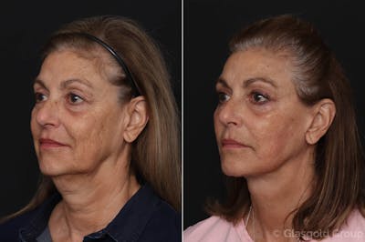 Lower Eyelid Before & After Gallery - Patient 462171 - Image 1