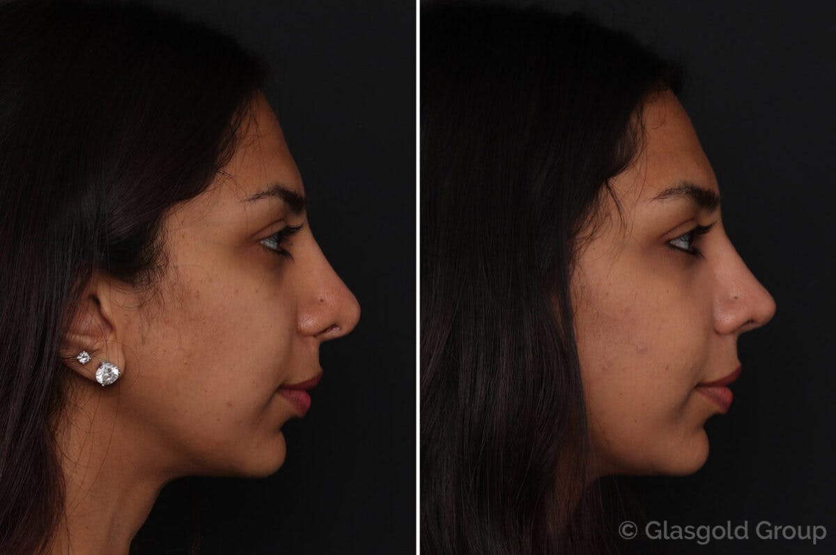Revision Rhinoplasty Before & After Gallery - Patient 460655 - Image 1