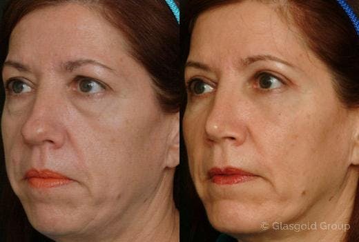 Lower Eyelid Before & After Gallery - Patient 338702 - Image 1