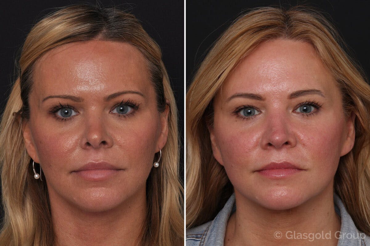 Revision Rhinoplasty Before & After Gallery - Patient 225025 - Image 2