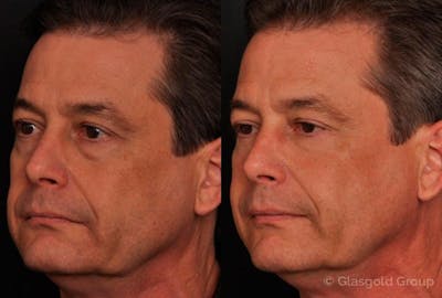 Lower Eyelid Before & After Gallery - Patient 193930 - Image 1