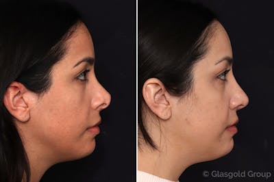Revision Rhinoplasty Before & After Gallery - Patient 994807 - Image 1