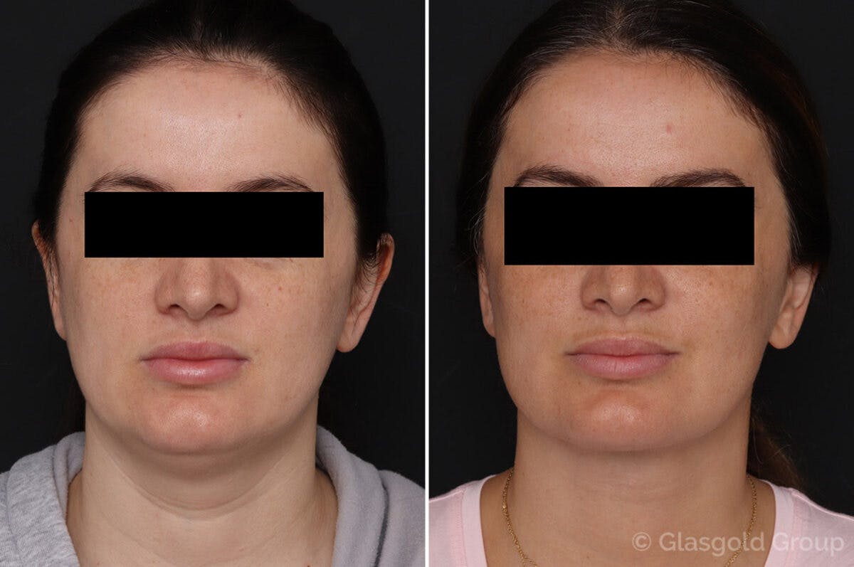 Neck Lift Before & After Gallery - Patient 757881 - Image 2