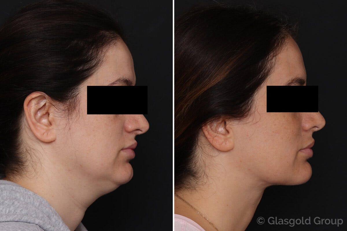 Neck Lift Before & After Gallery - Patient 757881 - Image 1