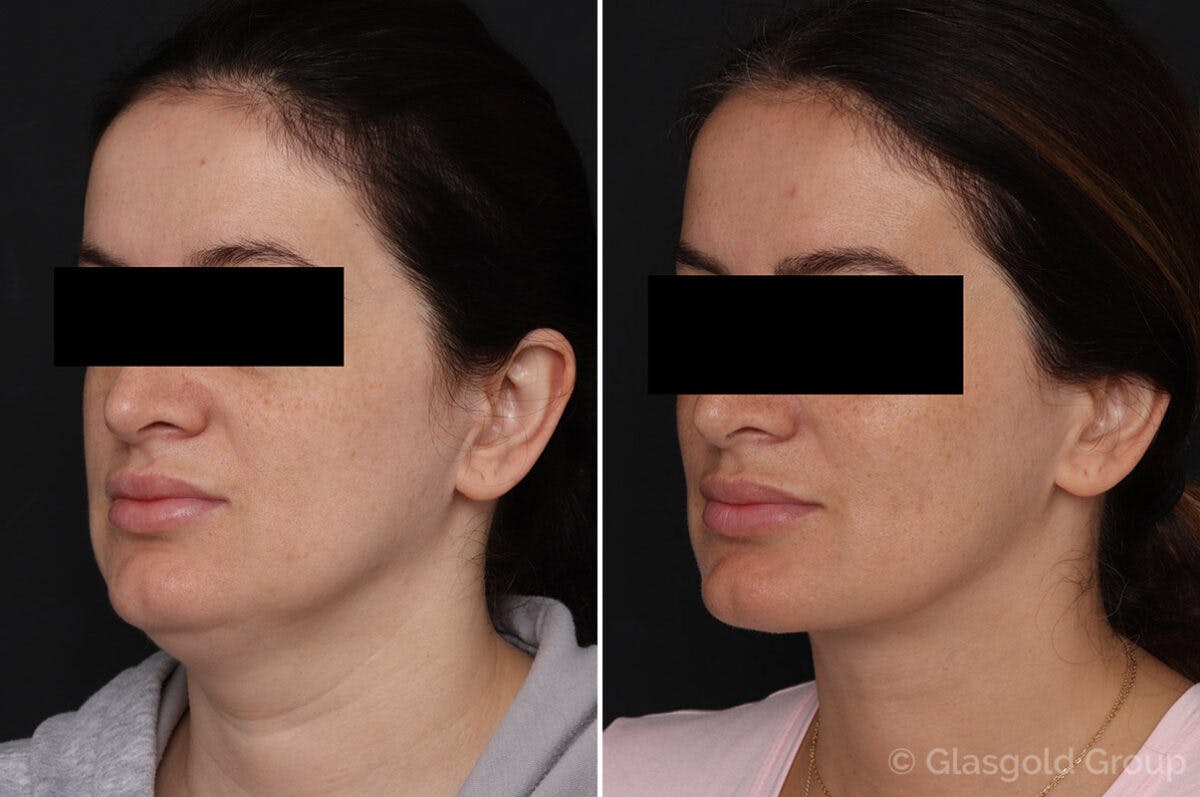 Neck Lift Before & After Gallery - Patient 757881 - Image 3