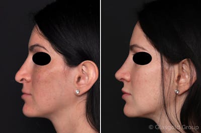 Revision Rhinoplasty Before & After Gallery - Patient 354323 - Image 1