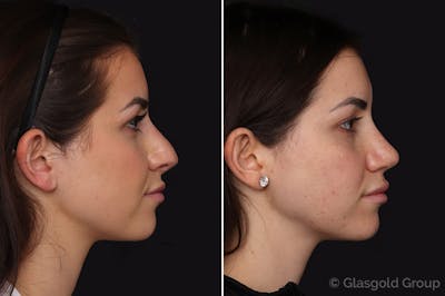 Revision Rhinoplasty Before & After Gallery - Patient 131064 - Image 1