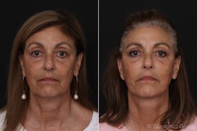Upper Eyelid Before & After Gallery - Patient 286924 - Image 1