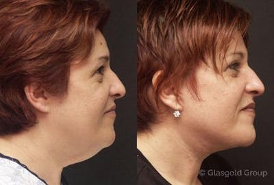 Neck Lift Before & After Gallery - Patient 524847 - Image 1