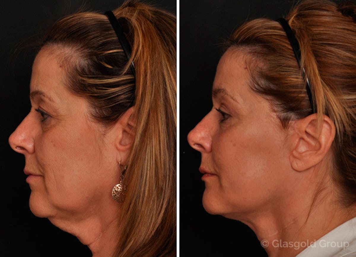 Lower Eyelid Before & After Gallery - Patient 418014 - Image 2