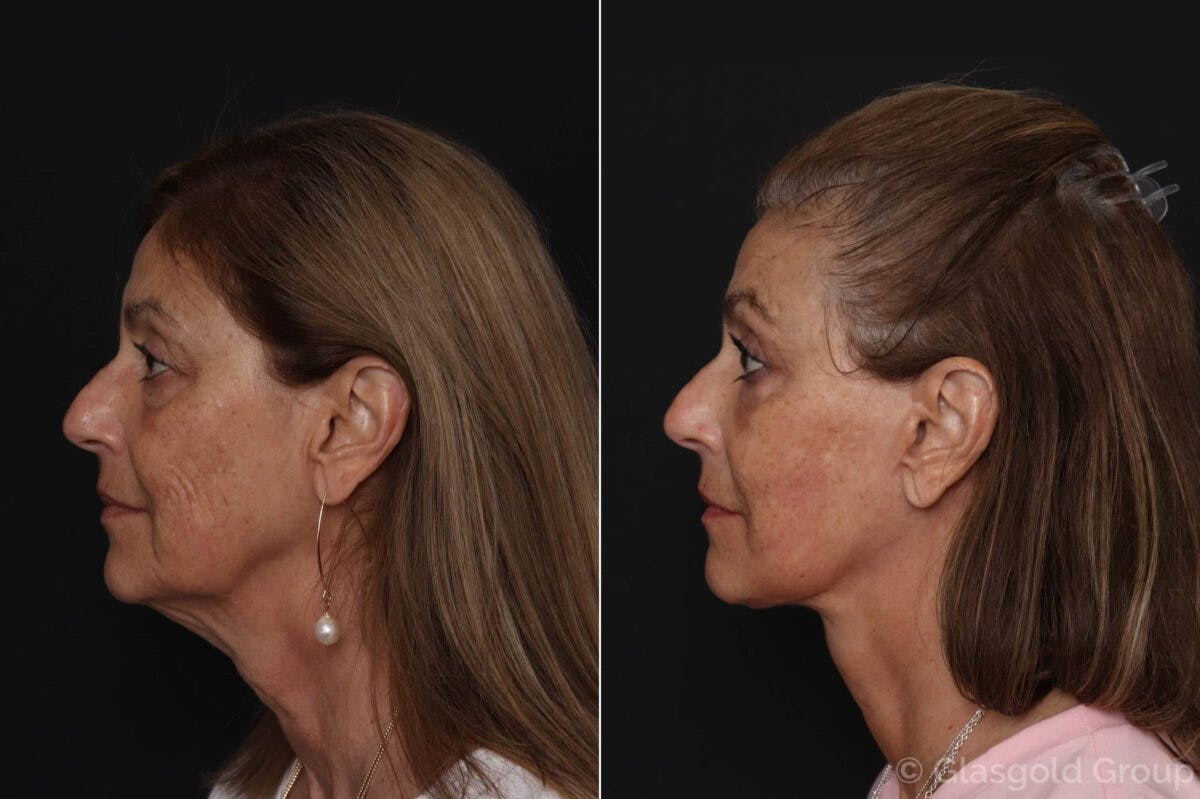 Upper Eyelid Before & After Gallery - Patient 286924 - Image 2
