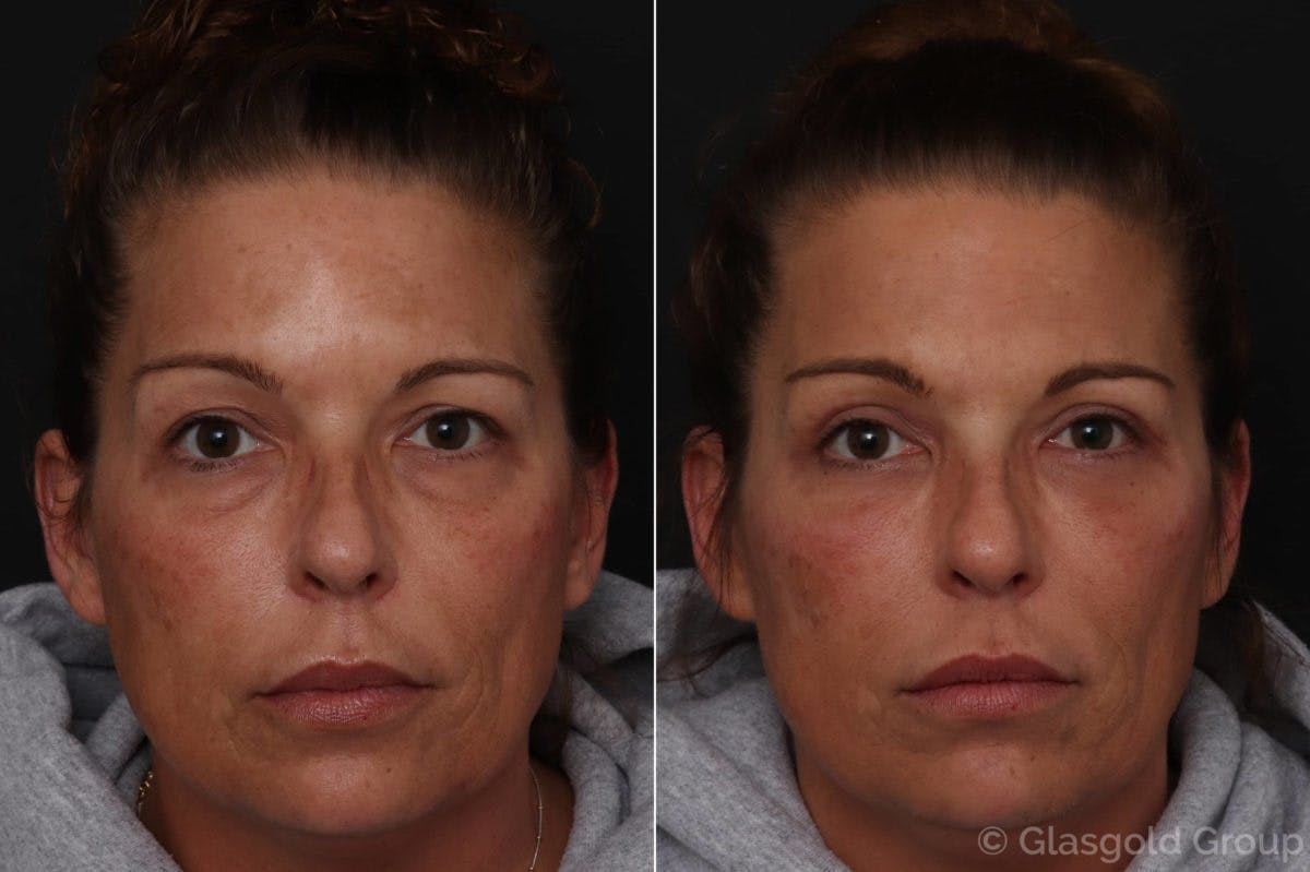 Upper Eyelid Before & After Gallery - Patient 194239 - Image 3
