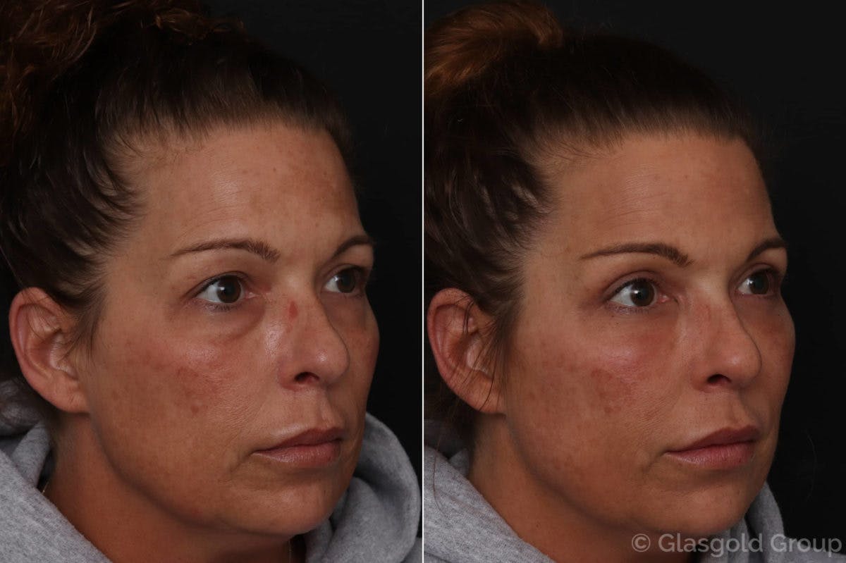 Upper Eyelid Before & After Gallery - Patient 194239 - Image 2