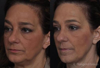 Lower Eyelid Before & After Gallery - Patient 345704 - Image 1