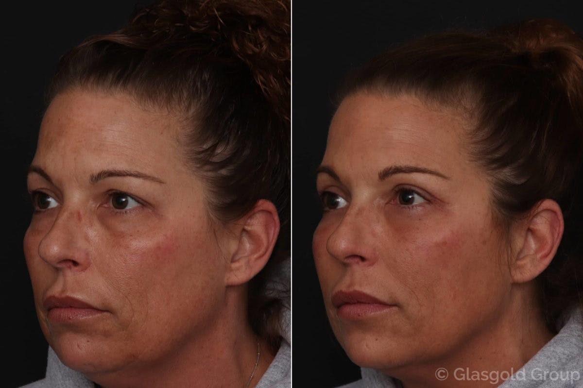 Upper Eyelid Before & After Gallery - Patient 194239 - Image 1