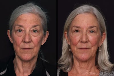 Upper Eyelid Before & After Gallery - Patient 187206 - Image 1