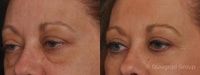 Lower Eyelid Before & After Gallery - Patient 348158 - Image 1