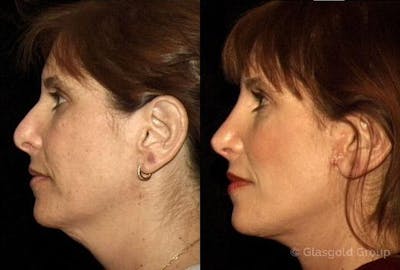Neck Lift Before & After Gallery - Patient 192069 - Image 1