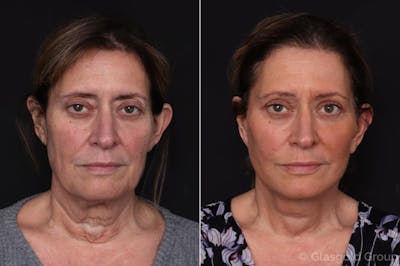 Upper Eyelid Before & After Gallery - Patient 410172 - Image 1