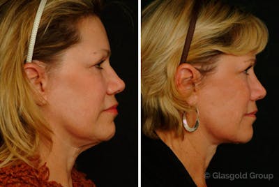 Neck Lift Before & After Gallery - Patient 187754 - Image 1