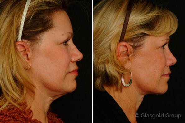 neck lift patient results