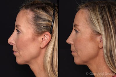 Revision Rhinoplasty Before & After Gallery - Patient 197448 - Image 1
