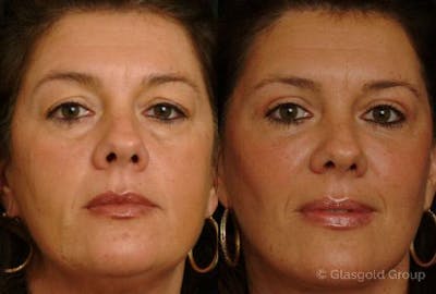Upper Eyelid Before & After Gallery - Patient 328104 - Image 1